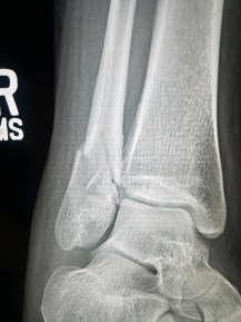 broken ankle